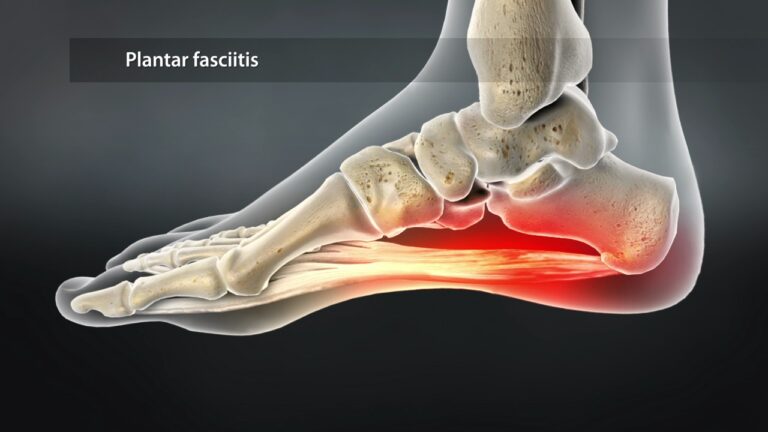 Plantar Fasciitis Archives - SPD Foundation